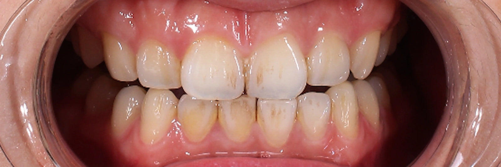 Before - Standard brush