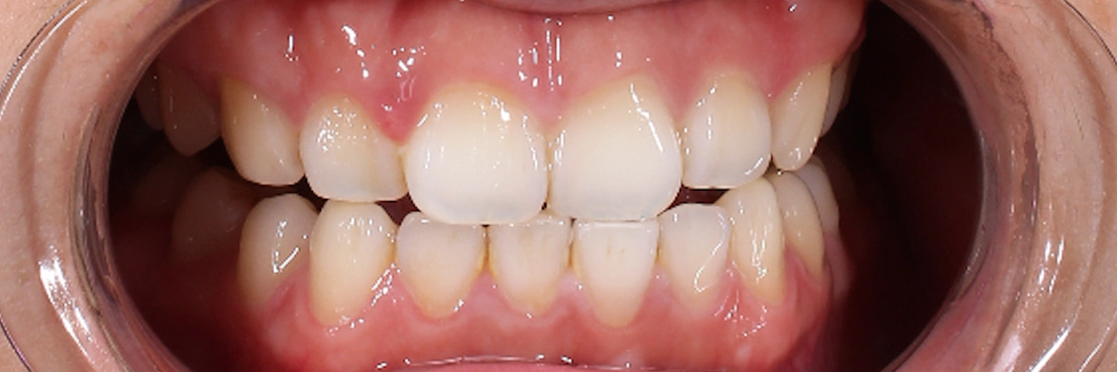 After - Blue light toothbrush